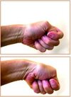 Orthopedie-Mortsel-De-Quervain-Tenosynovitis-219x300.jpg