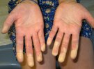 raynaud-fenomeen-1.jpg