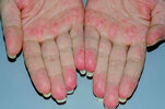 Vasculitis.jpg Vasculitis.jpg