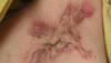 acne-inversa_hidradenitis-suppurativa-en-sinus-pilonidalis.png